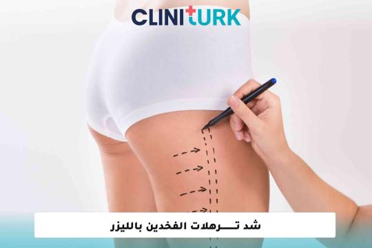 شد ترهلات الفخدين بالليزر